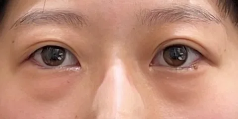症例2 術前