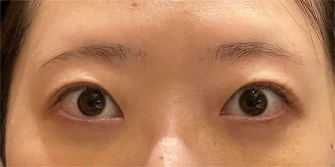 症例3 術後1週間