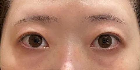 症例3 術前