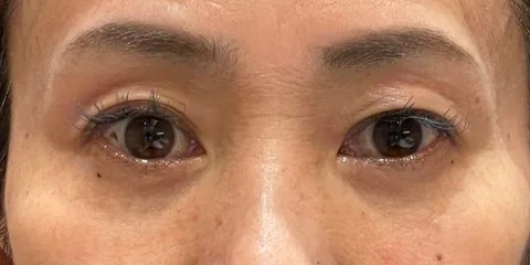 症例6 術後1か月