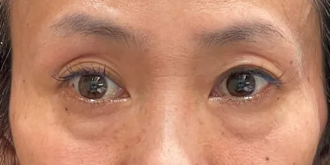症例6 術前